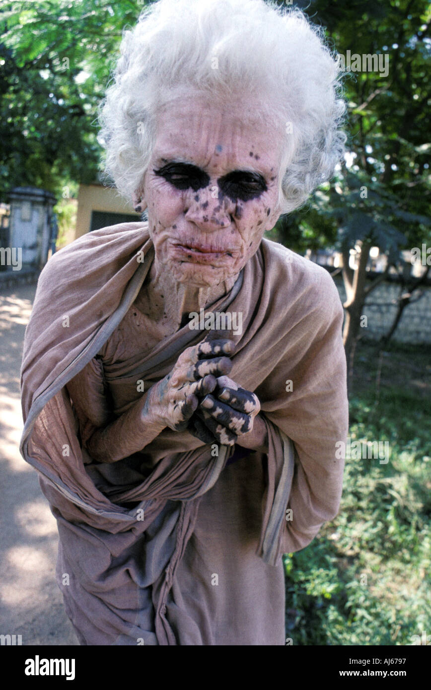 Indian woman with skin disorder begging outside an Ashram Stock Photo