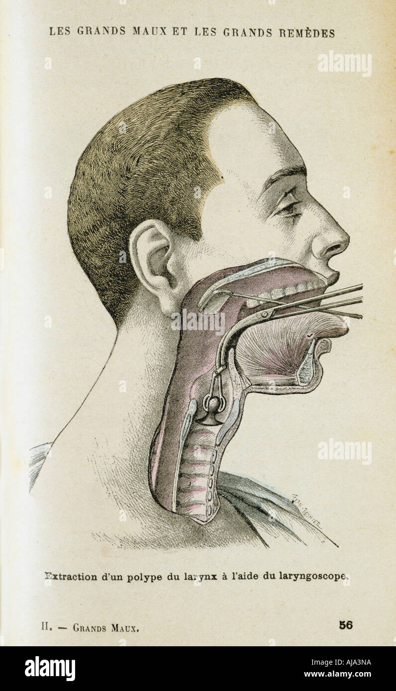 Using a laryngoscope to aid the removal of a polyp from the throat, c1890. Artist: Unknown Stock Photo