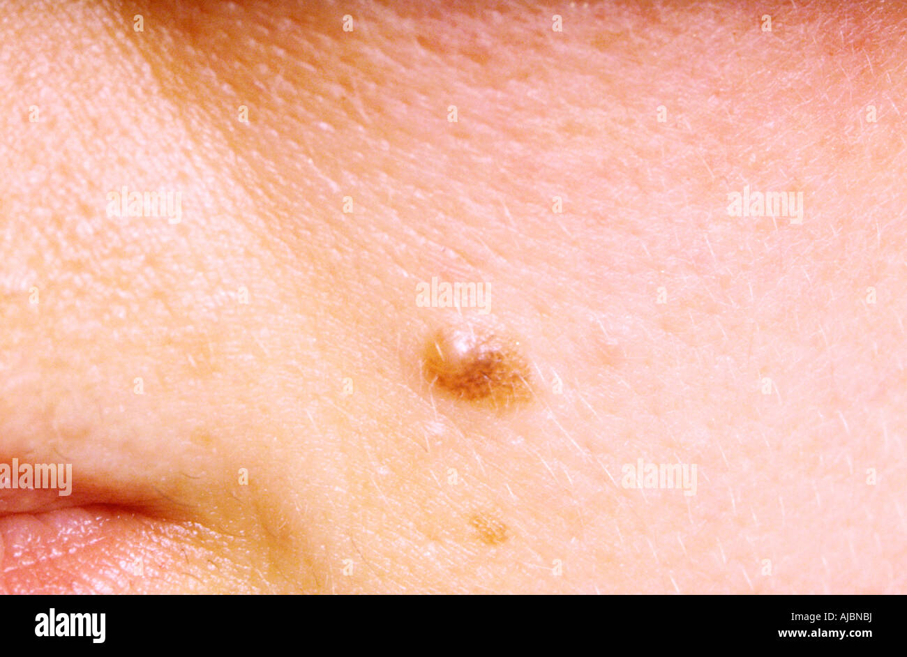 A picture of a stable malformation of the skin on the face producing a ...