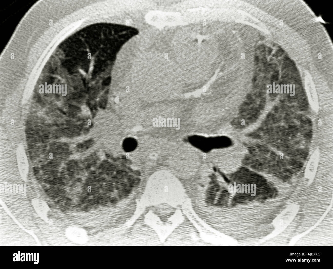 A CT Scan of Acute or adult respiratory distress syndrome (ARDS) Stock Photo