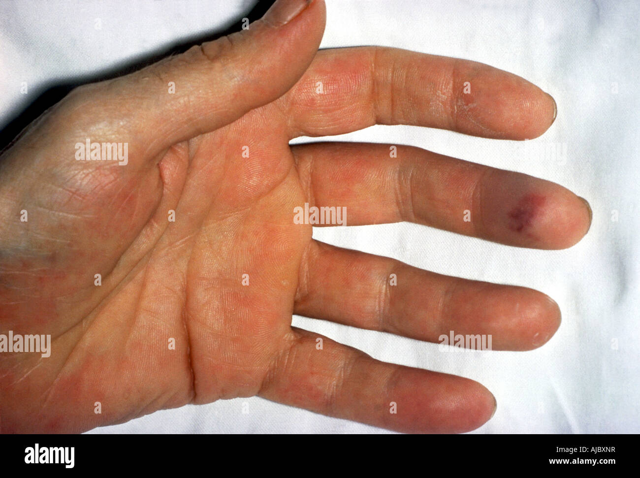 A patient with subacture bacterial endocarditis Stock Photo