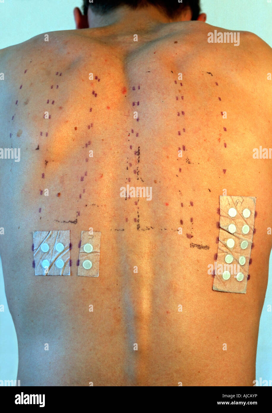 with month old allergy milk 8 year old man from showing his allergy back marked test 30