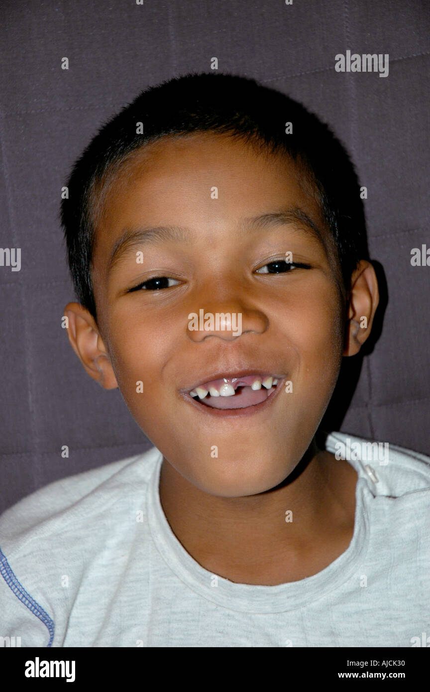 boy wisdom tooth Stock Photo - Alamy