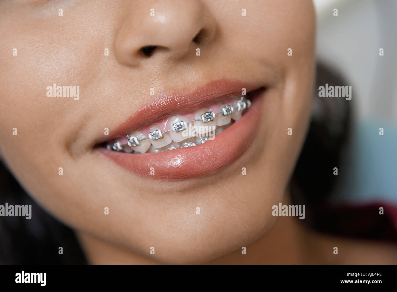 Teenage Girl Wearing Braces High Resolution Stock Photography and