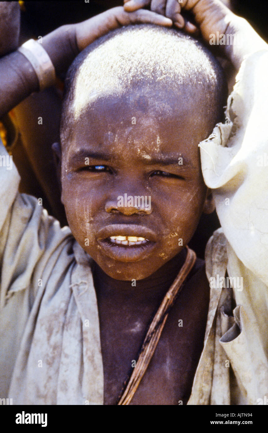 Moubi Sudan Refugee Camp Chadian Child Suffering From Dehydration Kwashiorkor Stock Photo