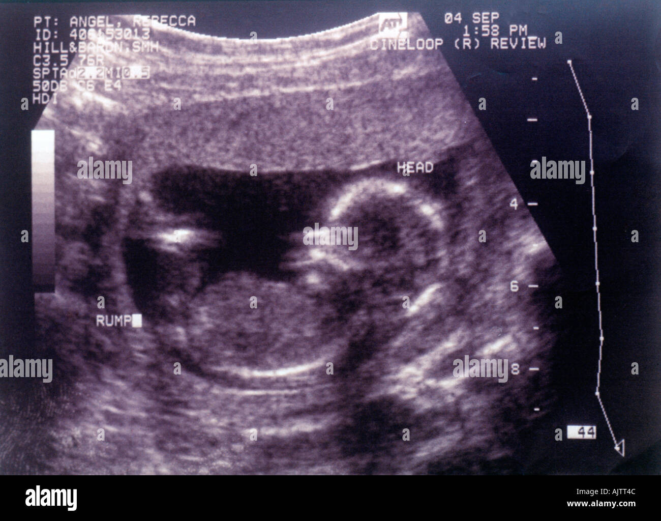 Ultrasound Scan Twenty Weeks Old Foetus Stock Photo