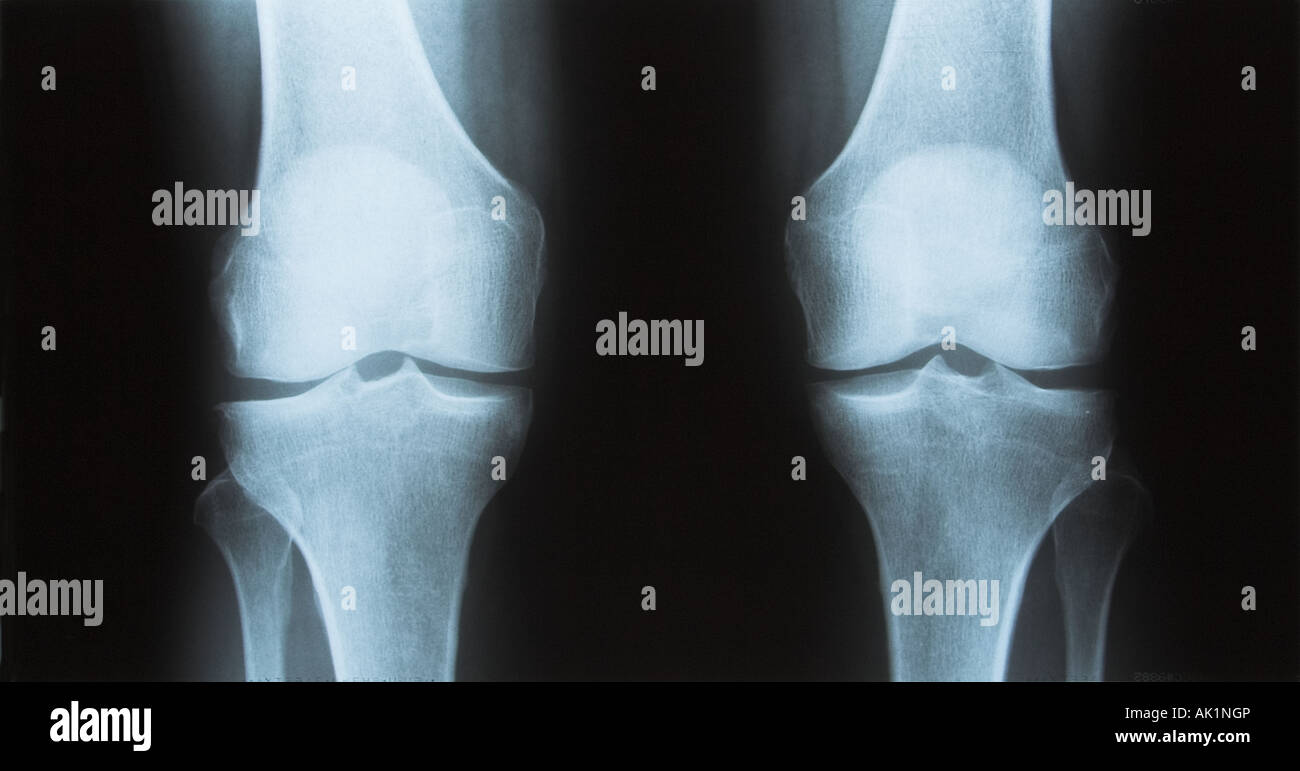 Knees x-ray Stock Photo