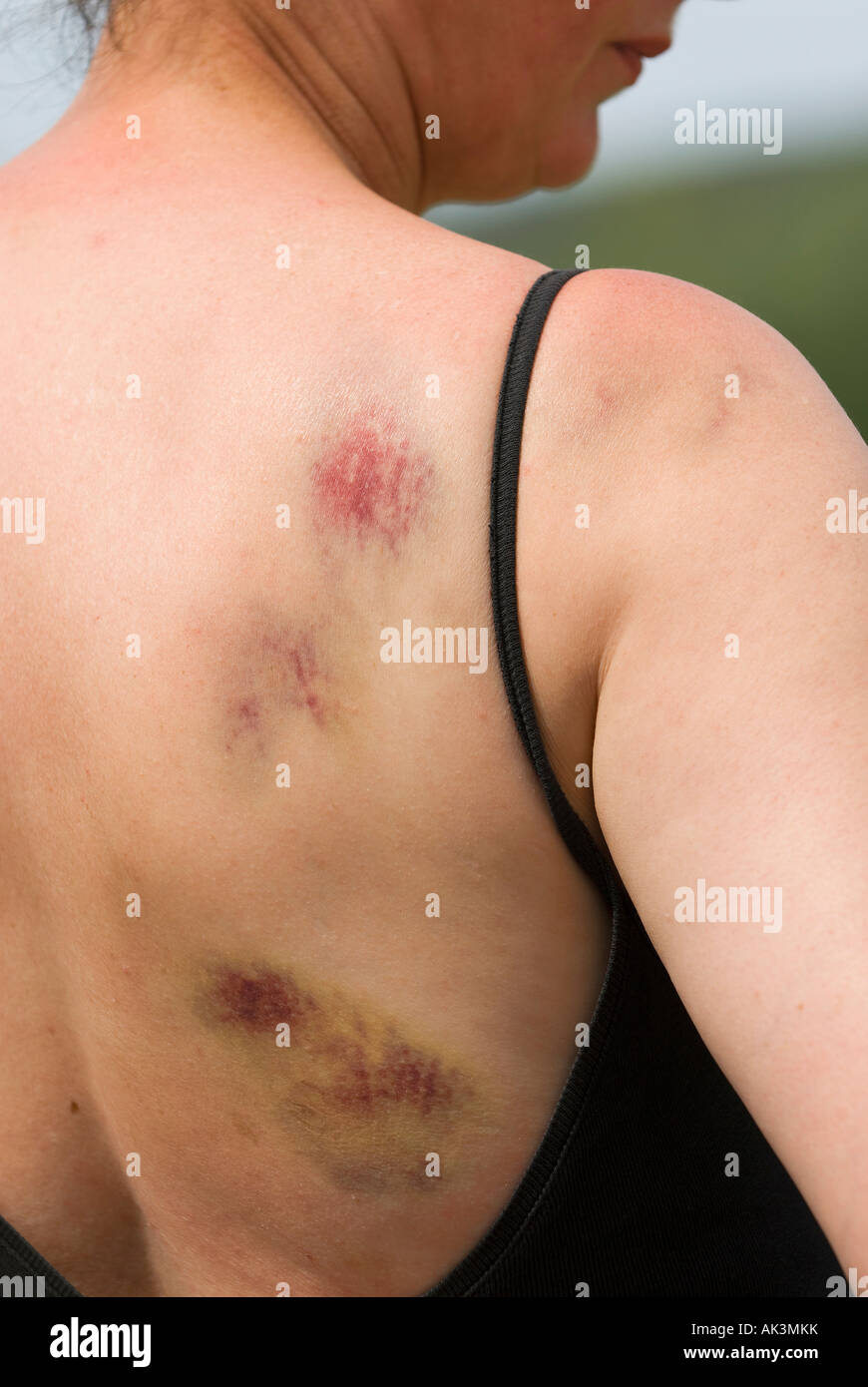 Bruises on back hi-res stock photography and images - Alamy