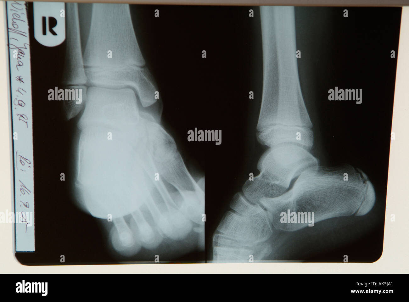 Radiograph Foot Stock Photos & Radiograph Foot Stock Images Alamy