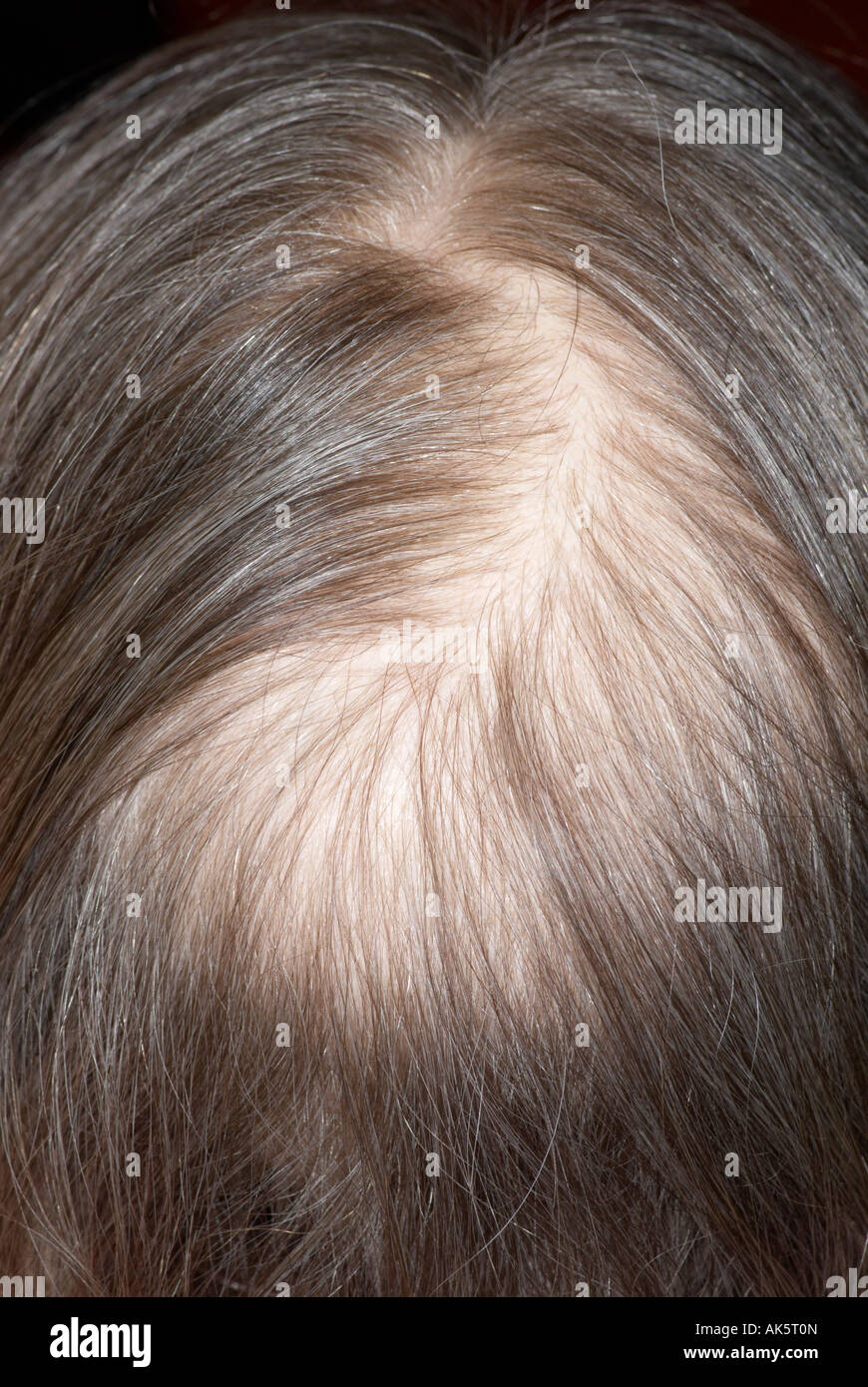 Thinning hair as a consequence of chemotherapy with hair brushed to show  patch Stock Photo - Alamy
