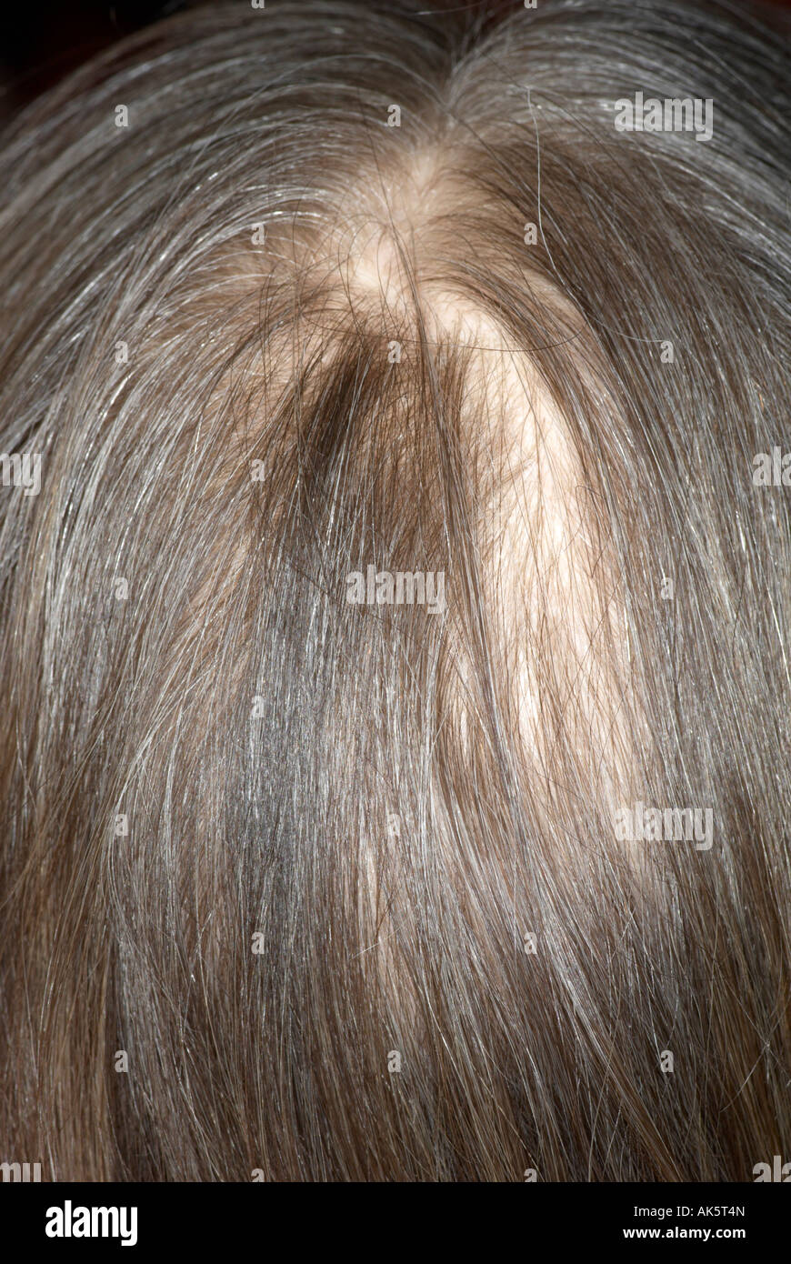 Thinning Hair As A Consequence Of Chemotherapy With Hair Brushed