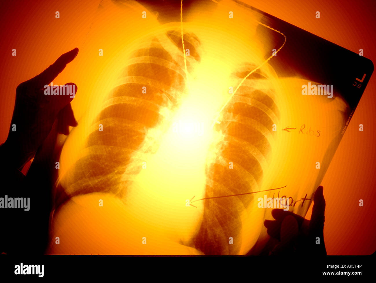 Chest x ray colored hires stock photography and images Alamy