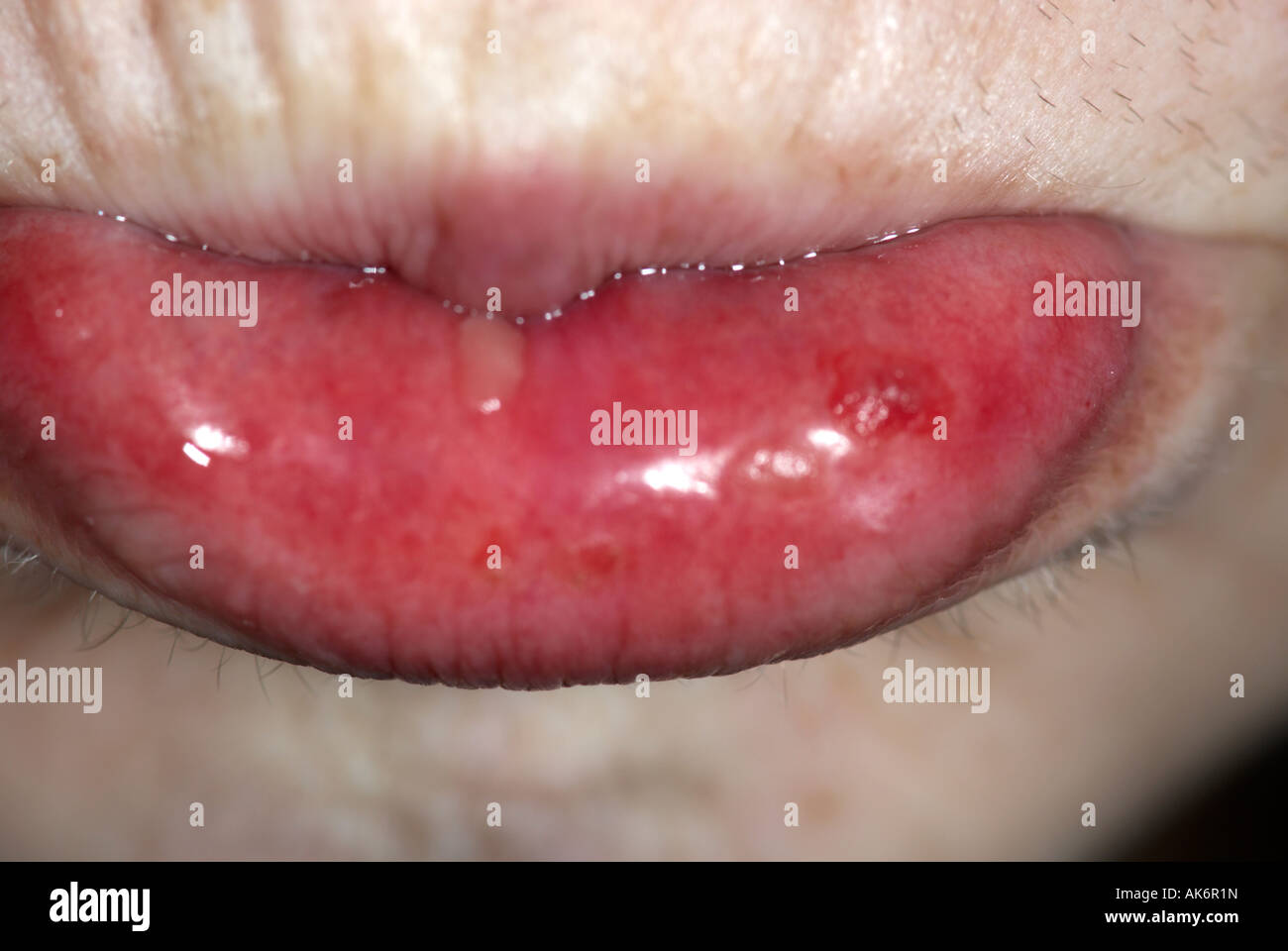 Mouth ulcers as a consequence of chemotherapy on female patient Stock Photo
