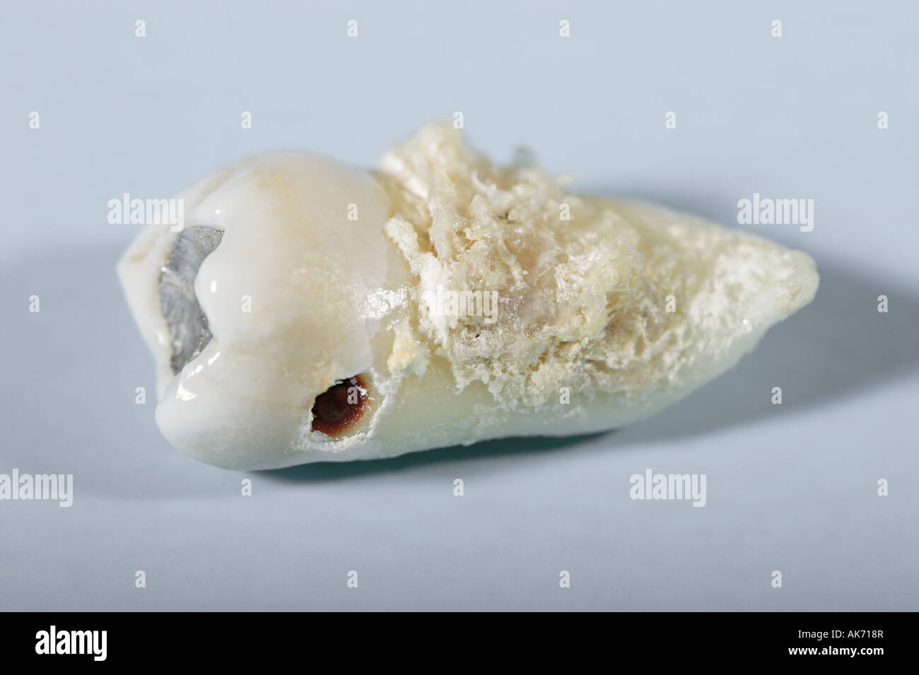 Extracted tooth with filling and signs of caries Stock Photo