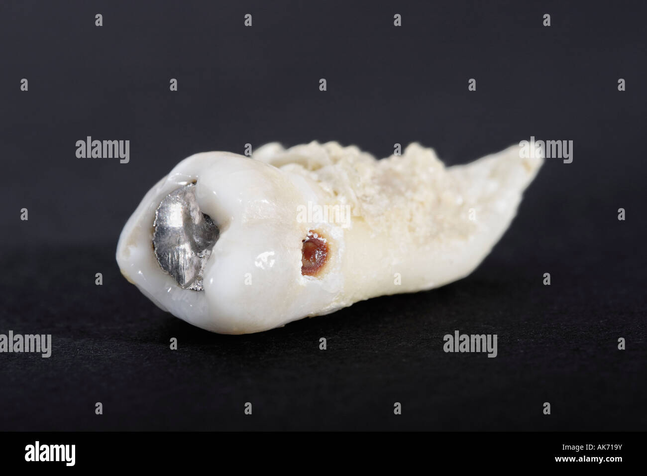 Extracted tooth with filling and signs of caries Stock Photo