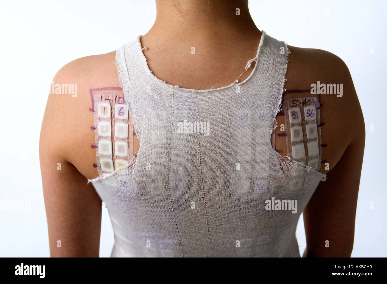 Allergy test patches on a young boy back. Stock Photo