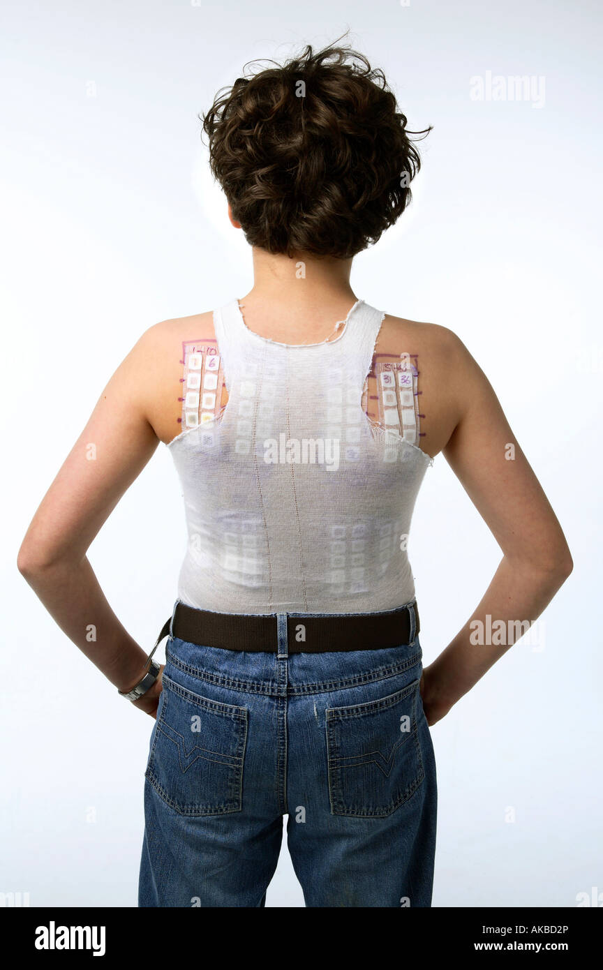 Patch tests stuck on the back of a woman, Tests for skin allergens