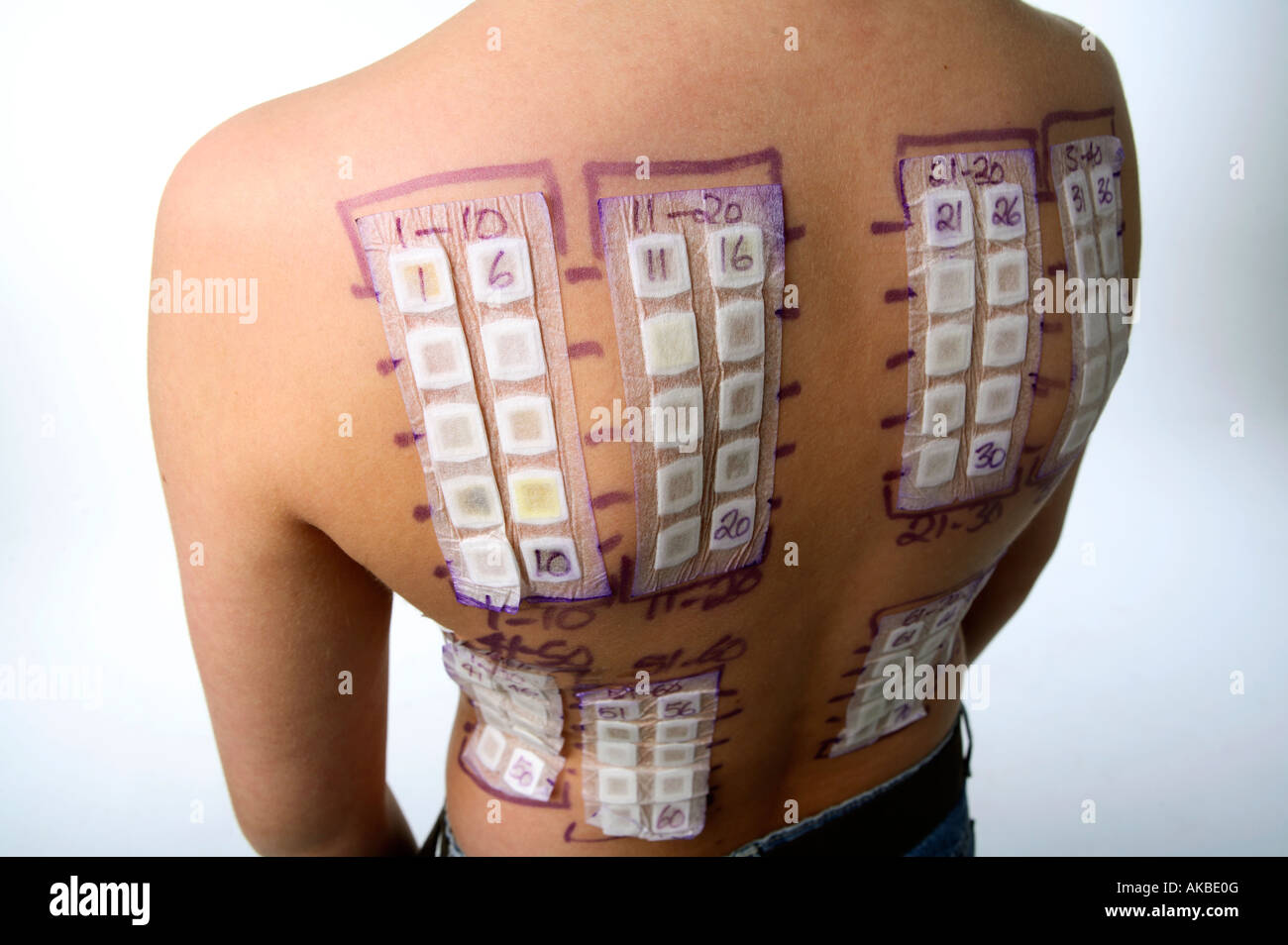 Allergy test patches on a young boy back. Stock Photo