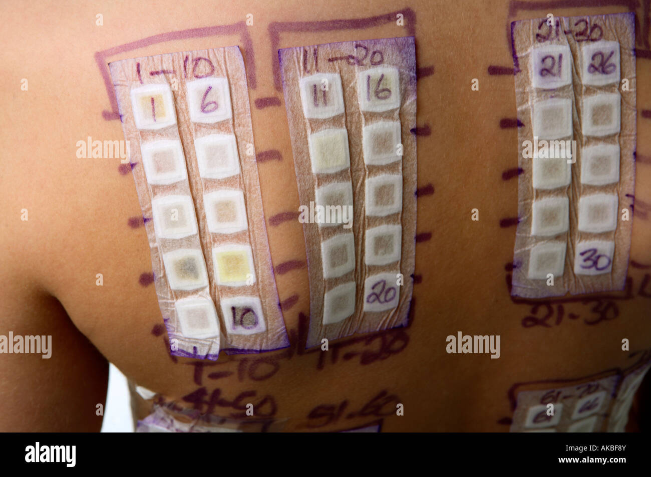 Allergy test patches on a young boy back Stock Photo Alamy