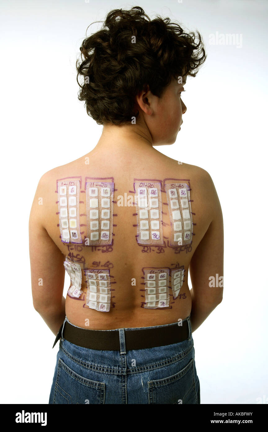 Allergy test patches on a young boy back Stock Photo Alamy