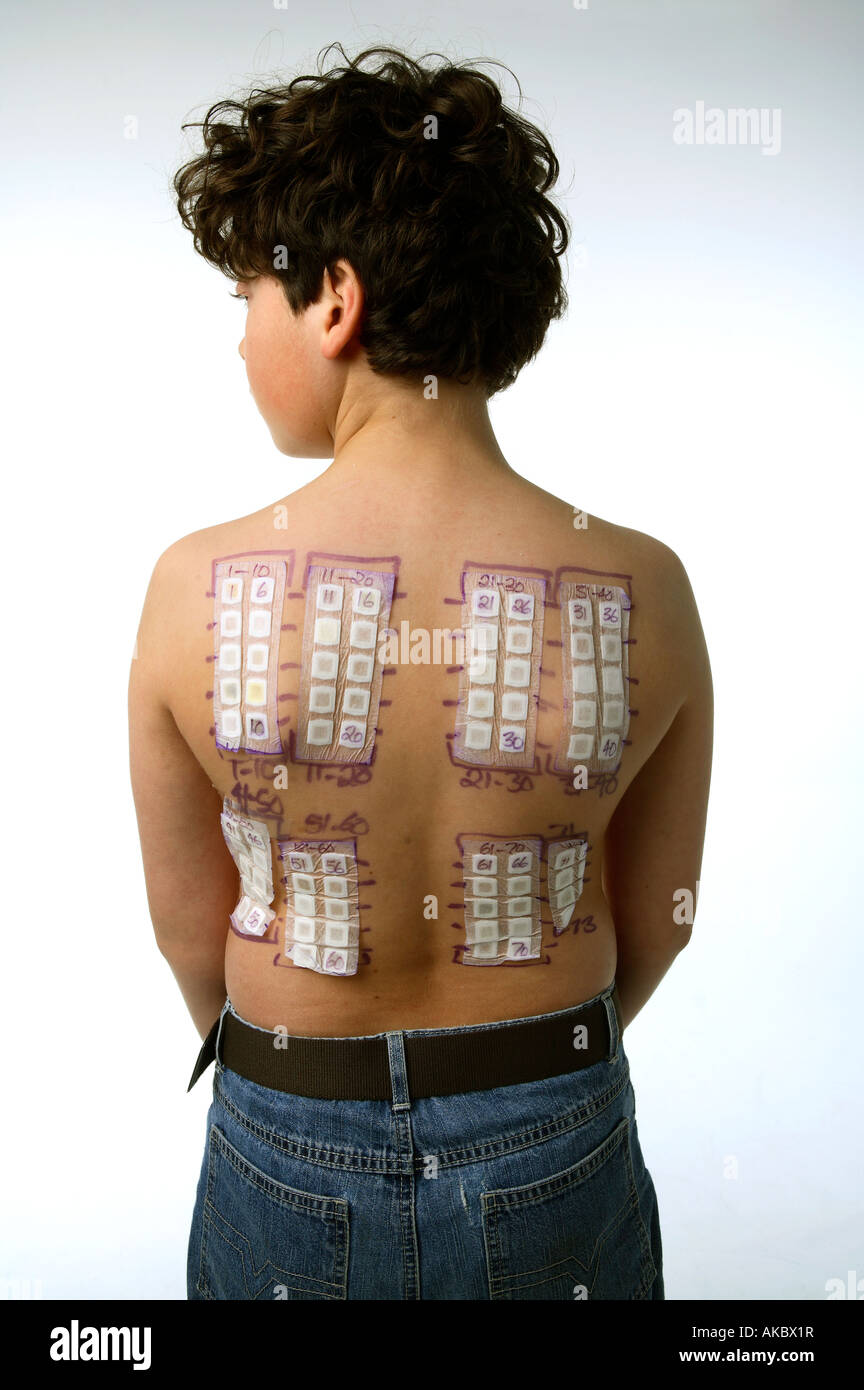 Allergy test patches on a young boy back Stock Photo Alamy