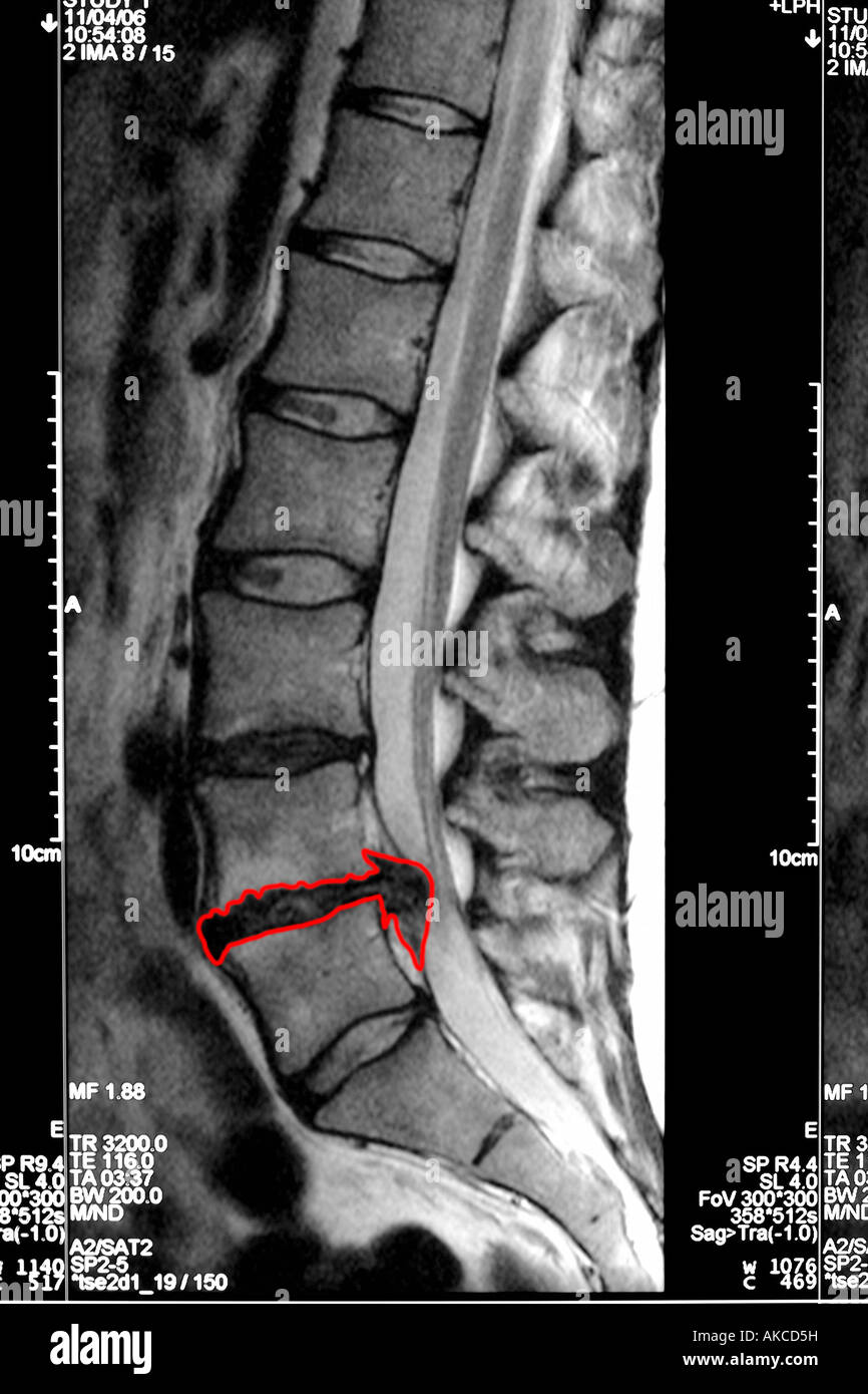 MRI scan clearly showing a slipped disc pressing on the spinal cord with the affected area outlined in red Stock Photo