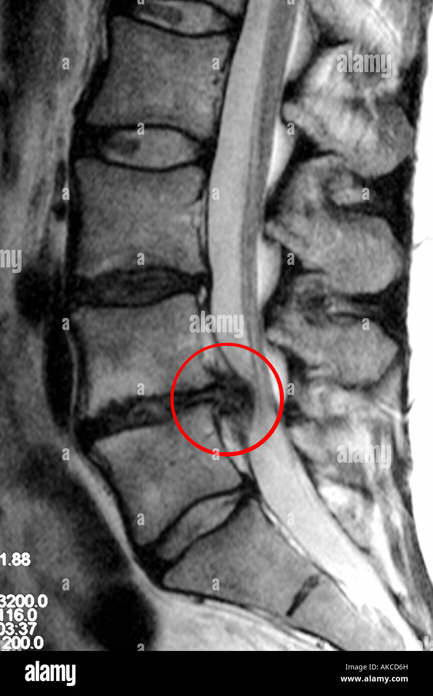 MRI scan clearly showing a slipped disc pressing on the spinal cord with the affected area circled in red Stock Photo