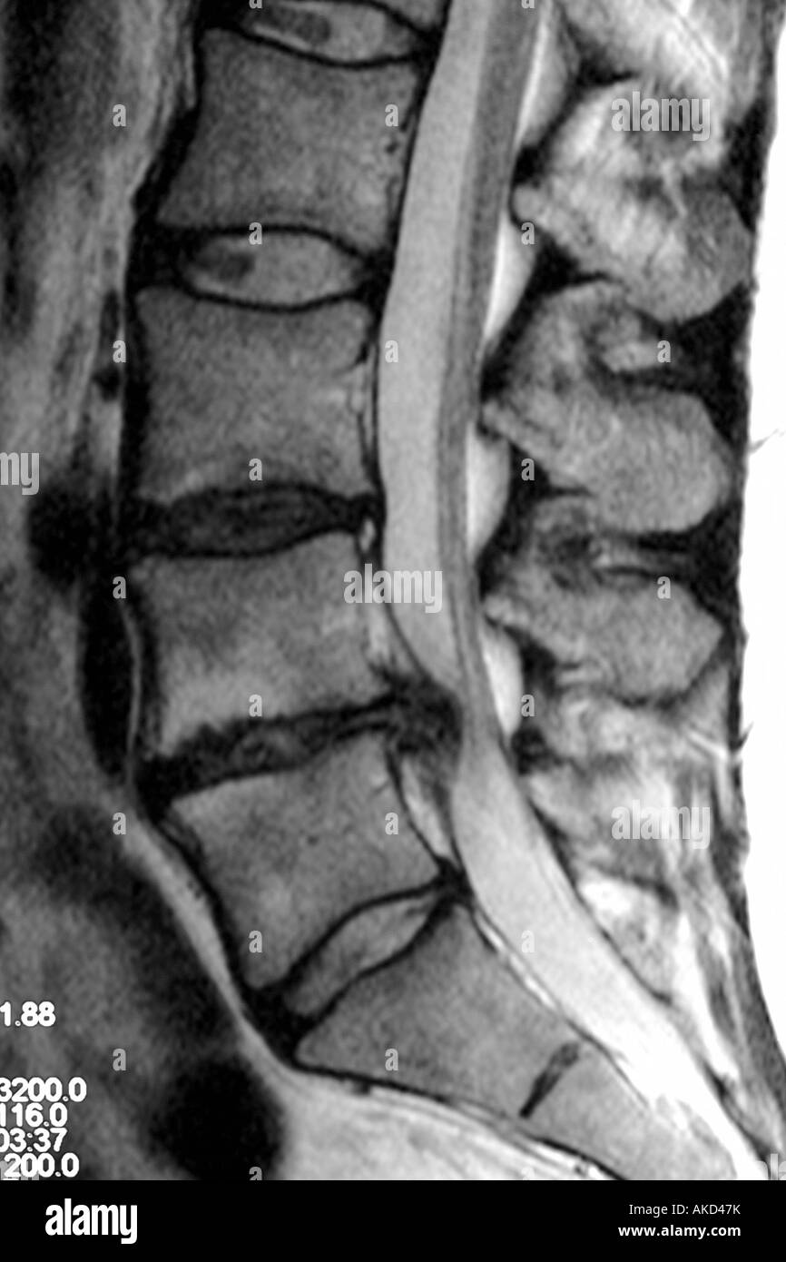 MRI scan clearly showing a slipped disc pressing on the spinal cord and causing severe pain Stock Photo