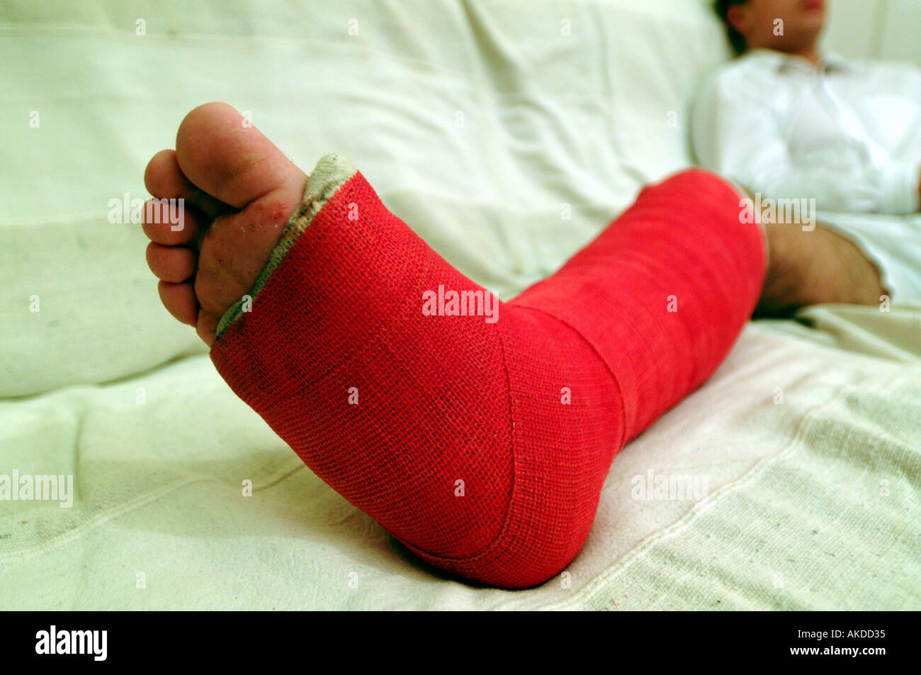 A young boys leg in plaster Stock Photo