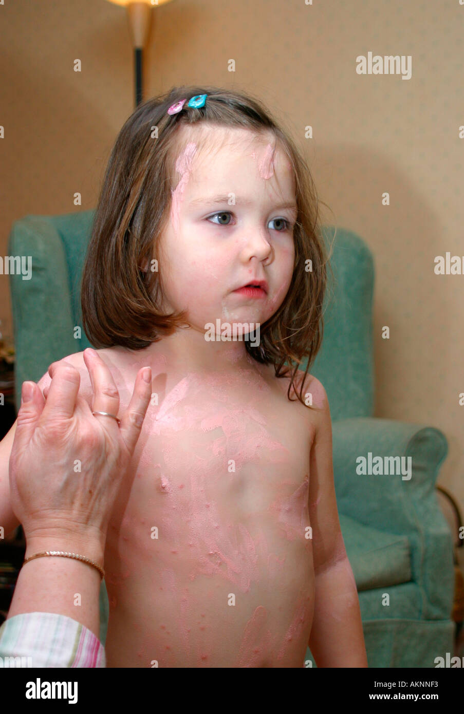  little girl chickenpox Alamy