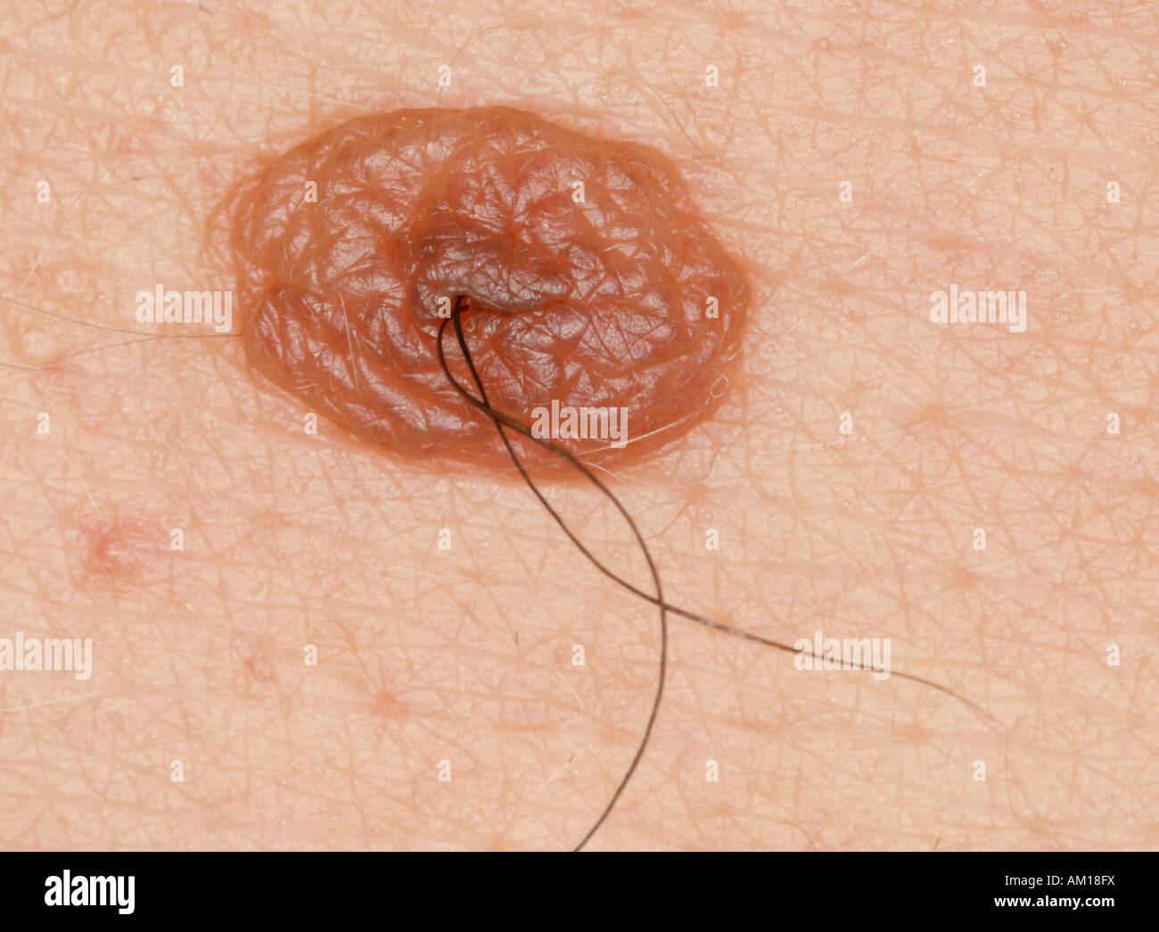 Hair growing on a wart Stock Photo - Alamy