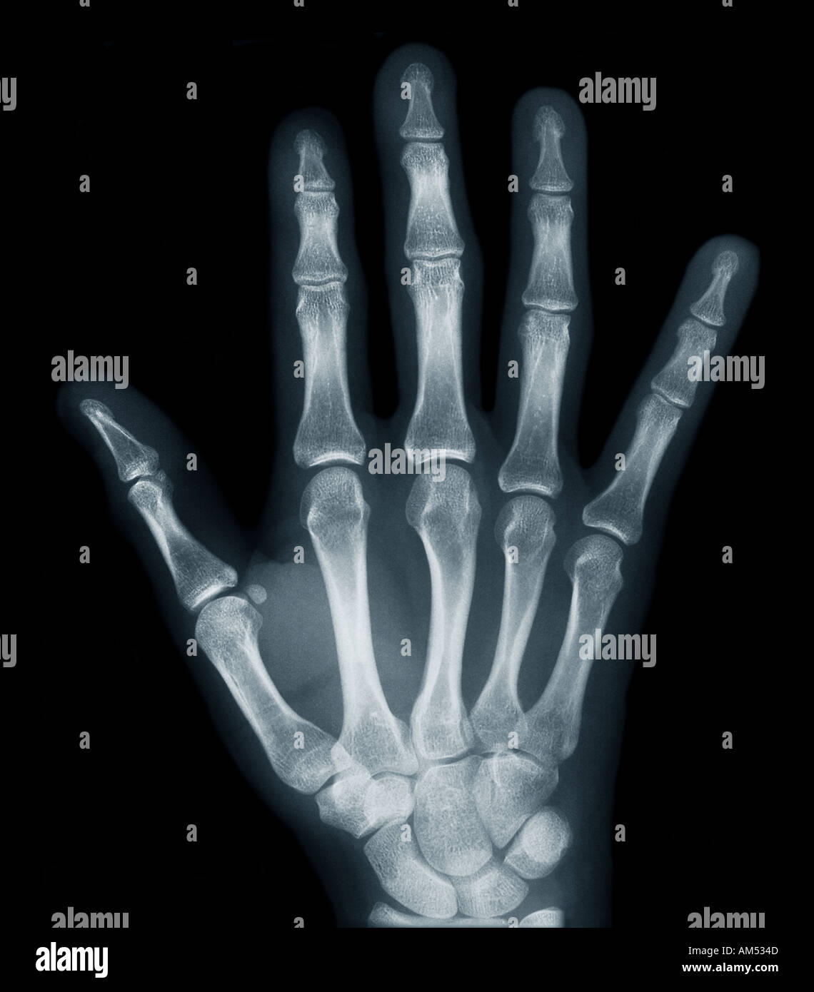 X ray of a human hand Stock Photo