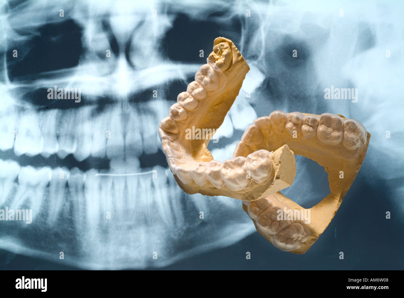 Dental x ray and plaster cast of teeth Stock Photo