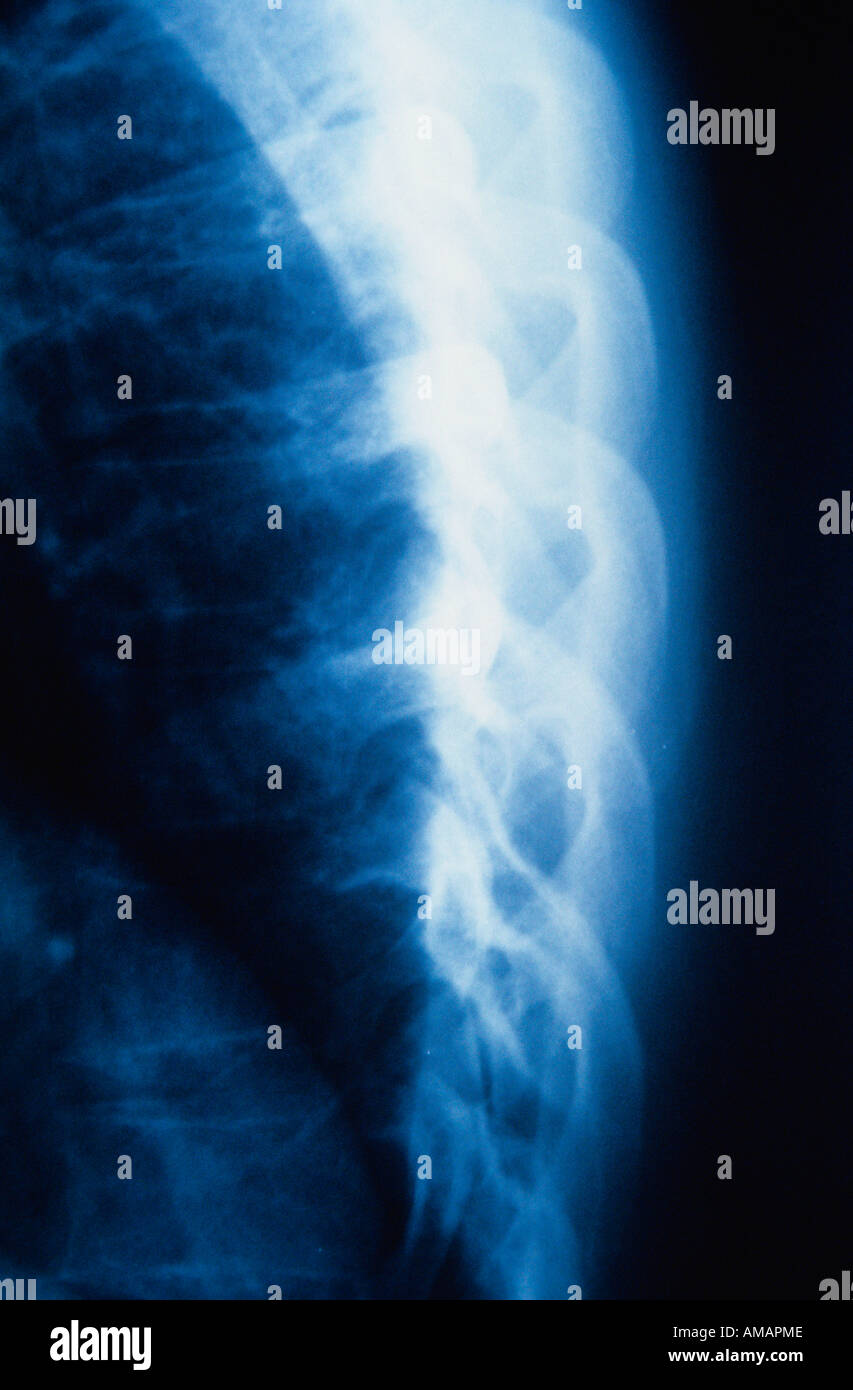 Chest x ray images hires stock photography and images Alamy
