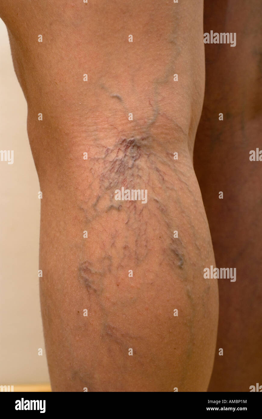 Thread veins of legs Stock Photo Alamy