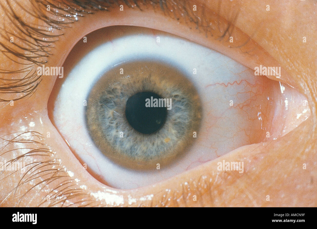 Wilson's disease - Kayser-Fleischer ring Stock Photo - Alamy