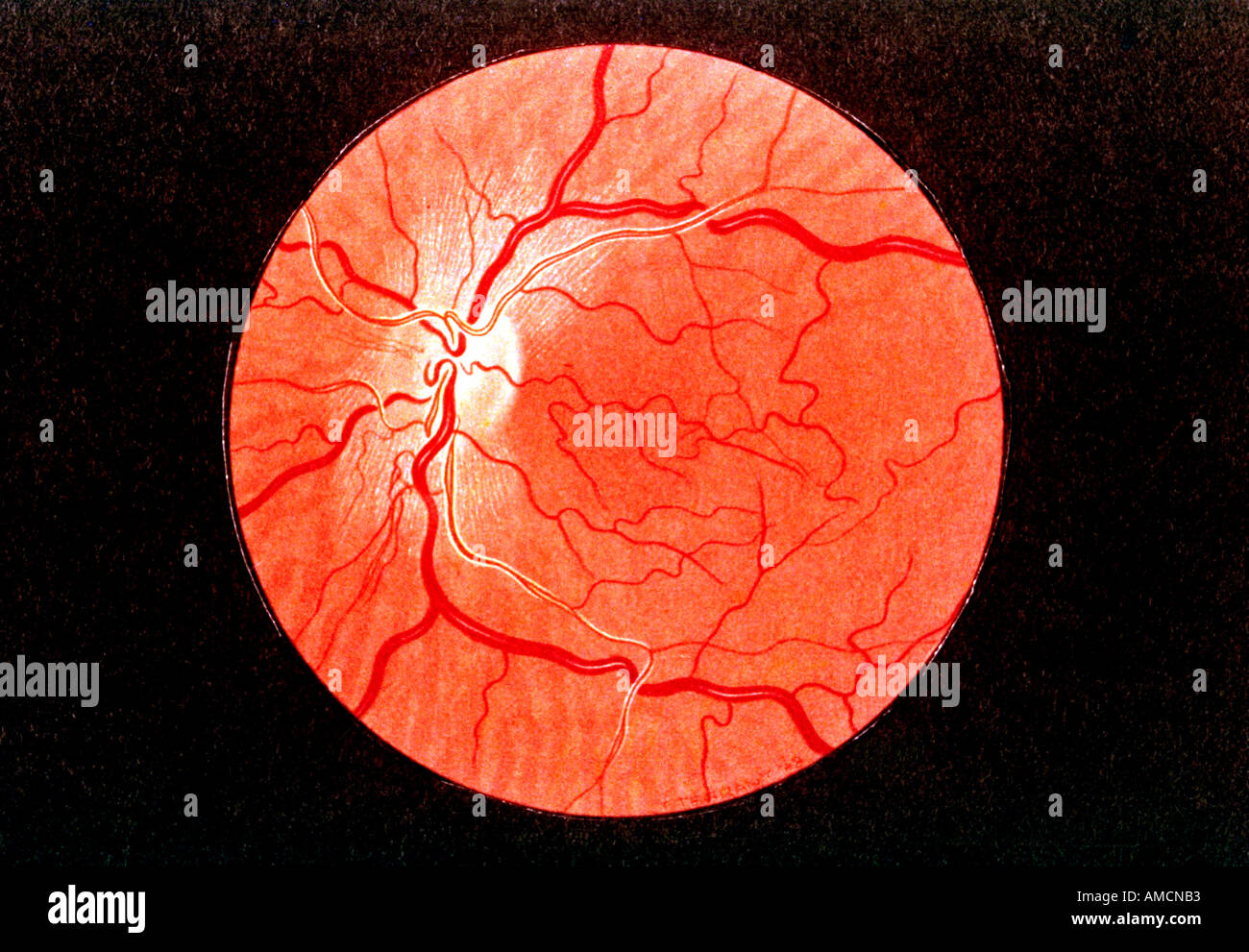 Diagram - arteriovenous nipping Stock Photo