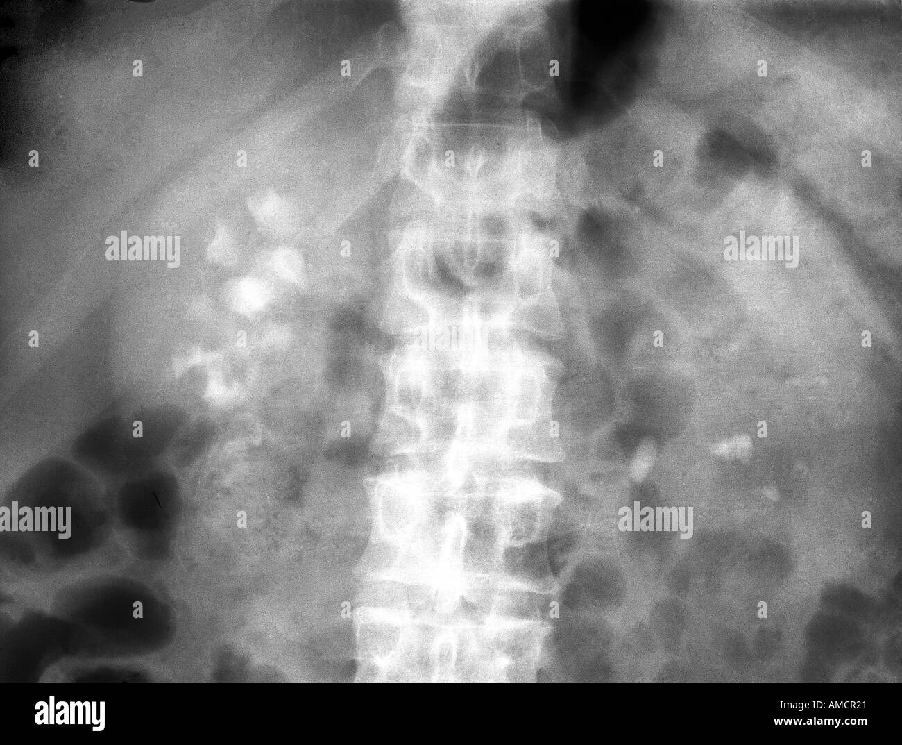 Xray kidney stones Stock Photo 4970272 Alamy