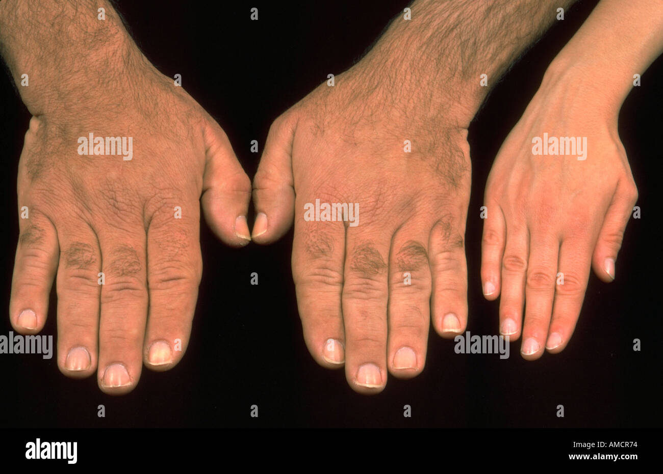 Acromegaly Stock Photo