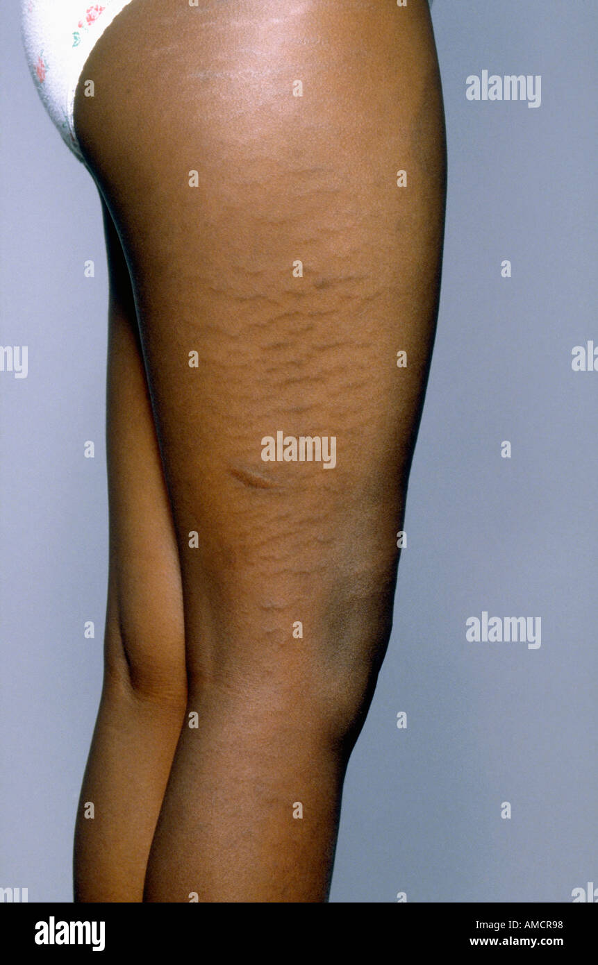 Stretch marks on legs hi-res stock photography and images - Alamy