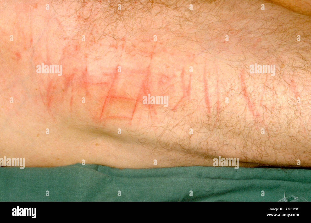 A photograph of a patient with scratches on the thigh due to self