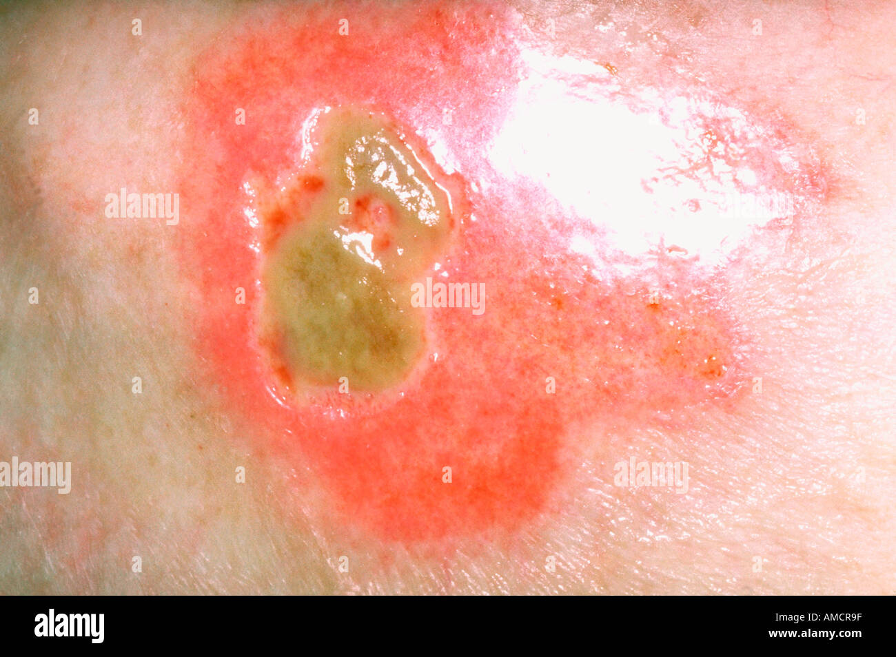 Pressure ulcer hires stock photography and images Alamy