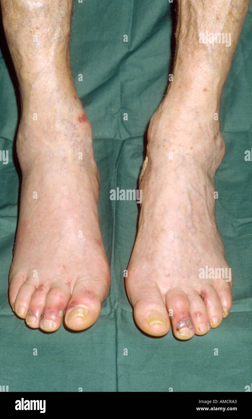 Vasculitis on feet hires stock photography and images Alamy