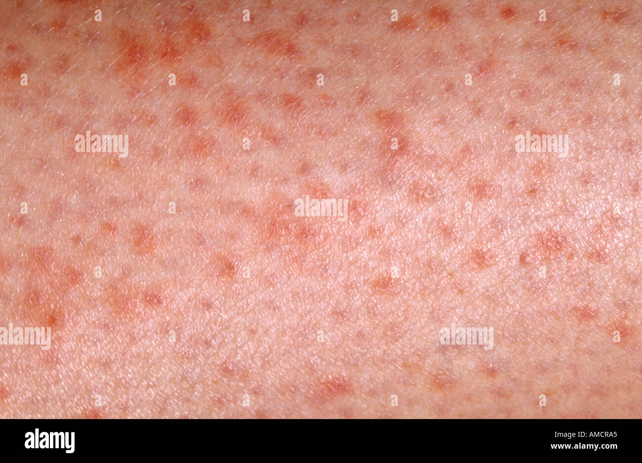 A photograph showing idiopathic thrombocytopenic purpura (ITP Stock Photo