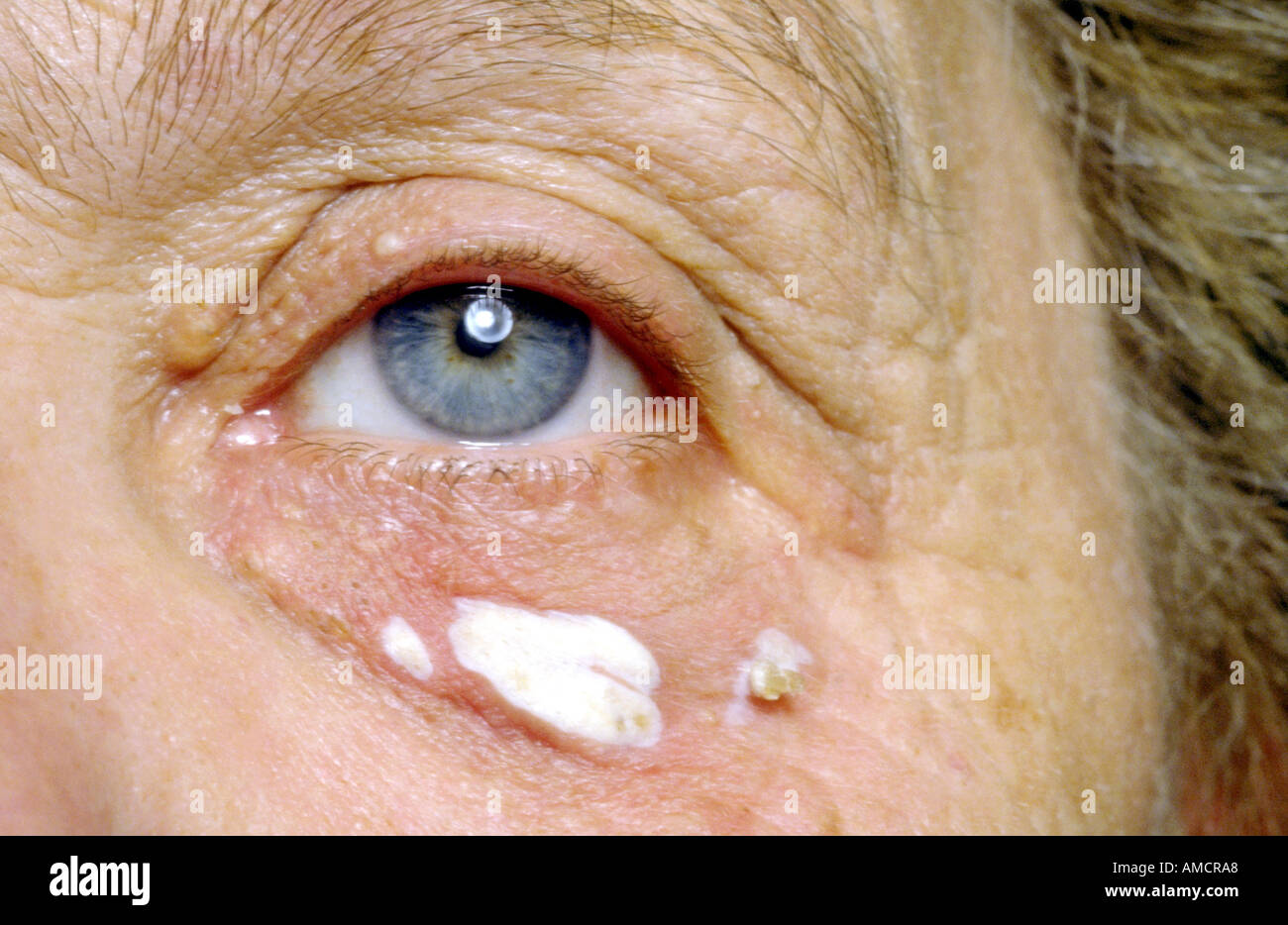 A photograph showing the development of xanthelasma palpebra, a common