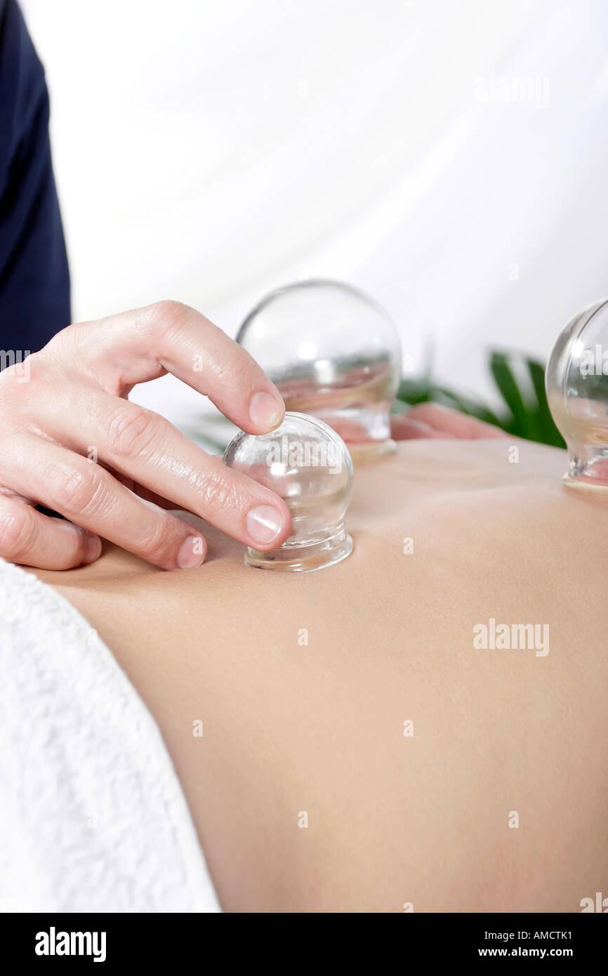 Woman receiving cupping acupuncture mid section Stock Photo