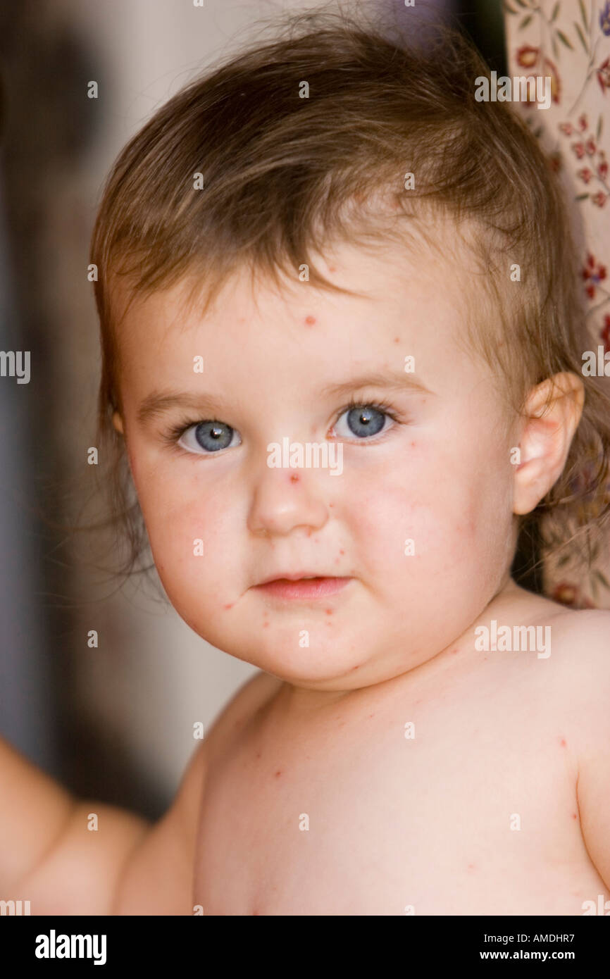 Little girl with itchy chicken pox spots and rash Stock Photo Alamy