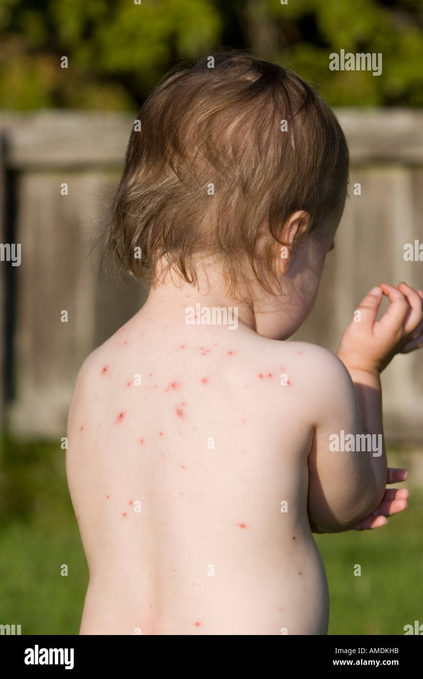 Little girl with itchy chicken pox spots and rash Stock Photo