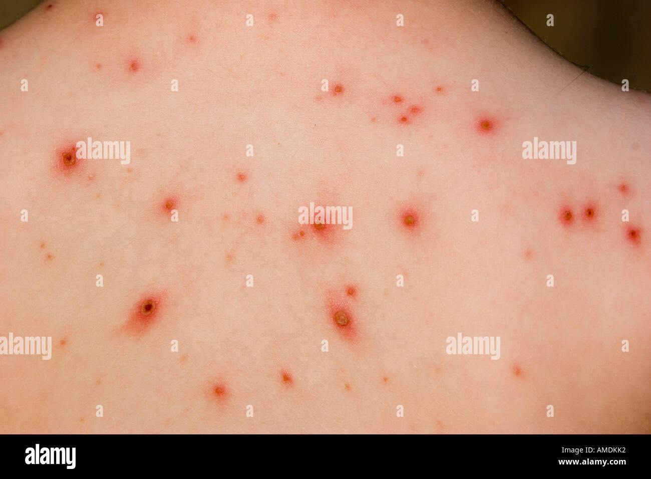 Little girl with itchy chicken pox spots and rash Stock Photo Alamy