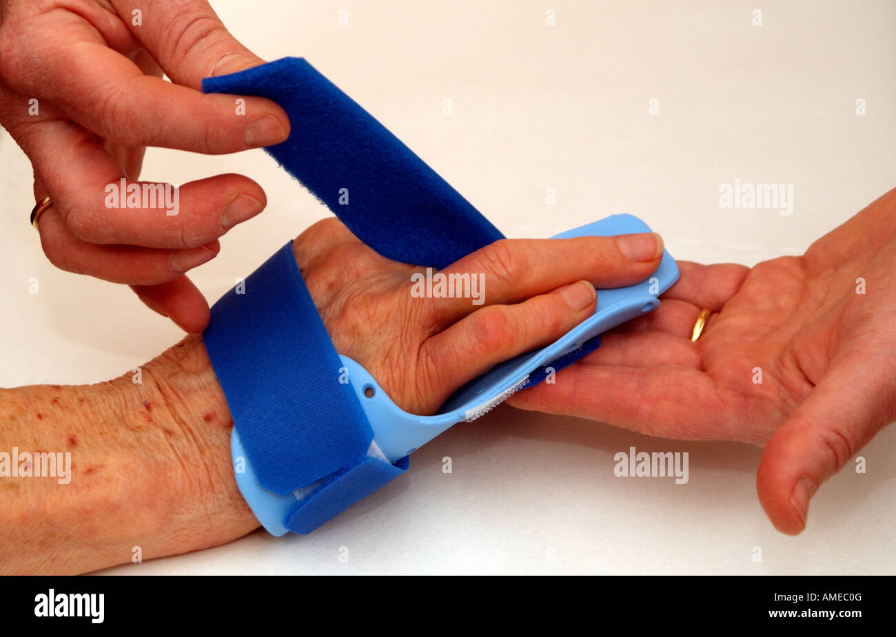 Dupuytrens Contracture Clinical Night Splint Fitting to Fingers and Hand Stock Photo Alamy
